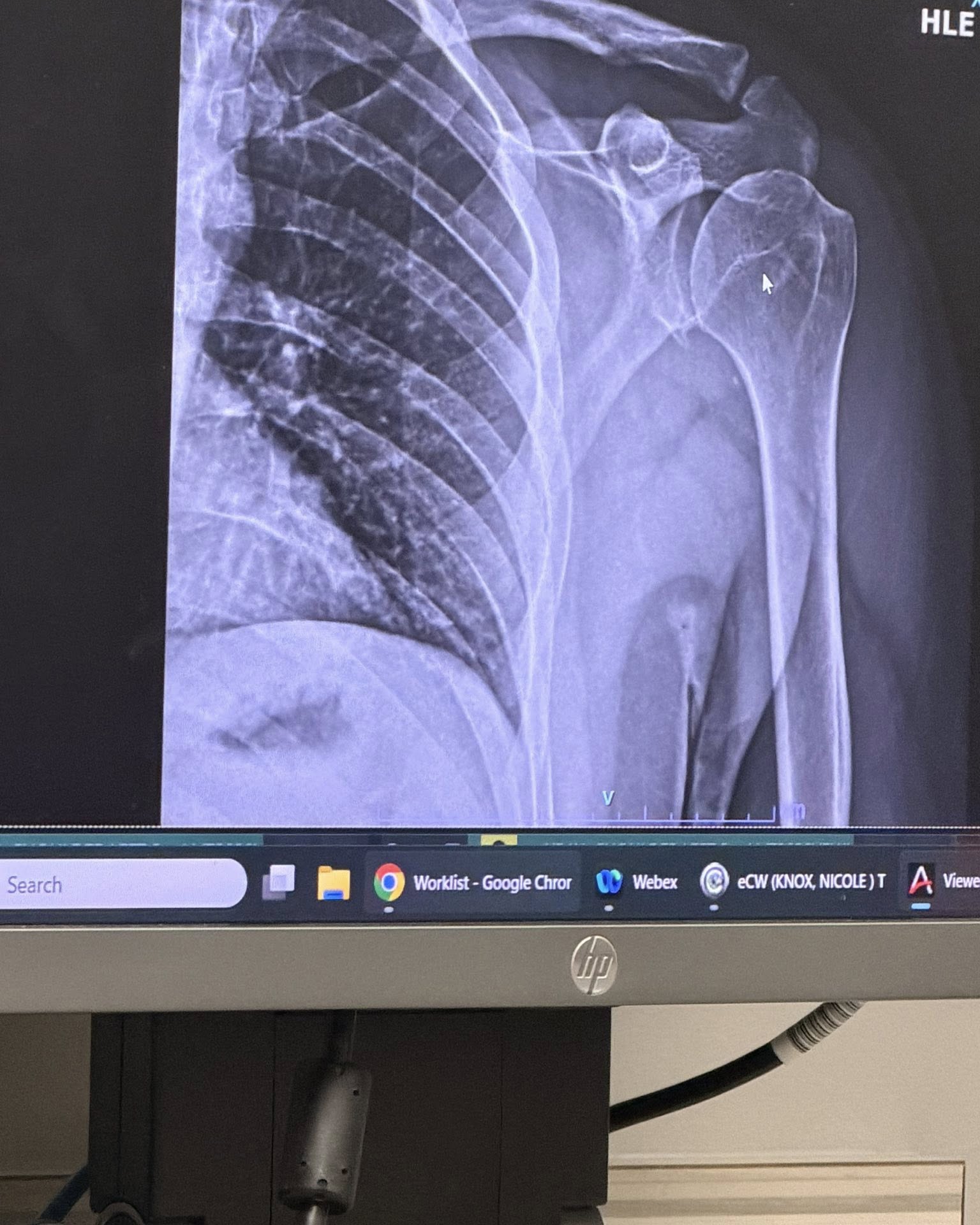 After years of my shoulder repeatedly dislocating, grinding, slipping out of place, and causing constant…
