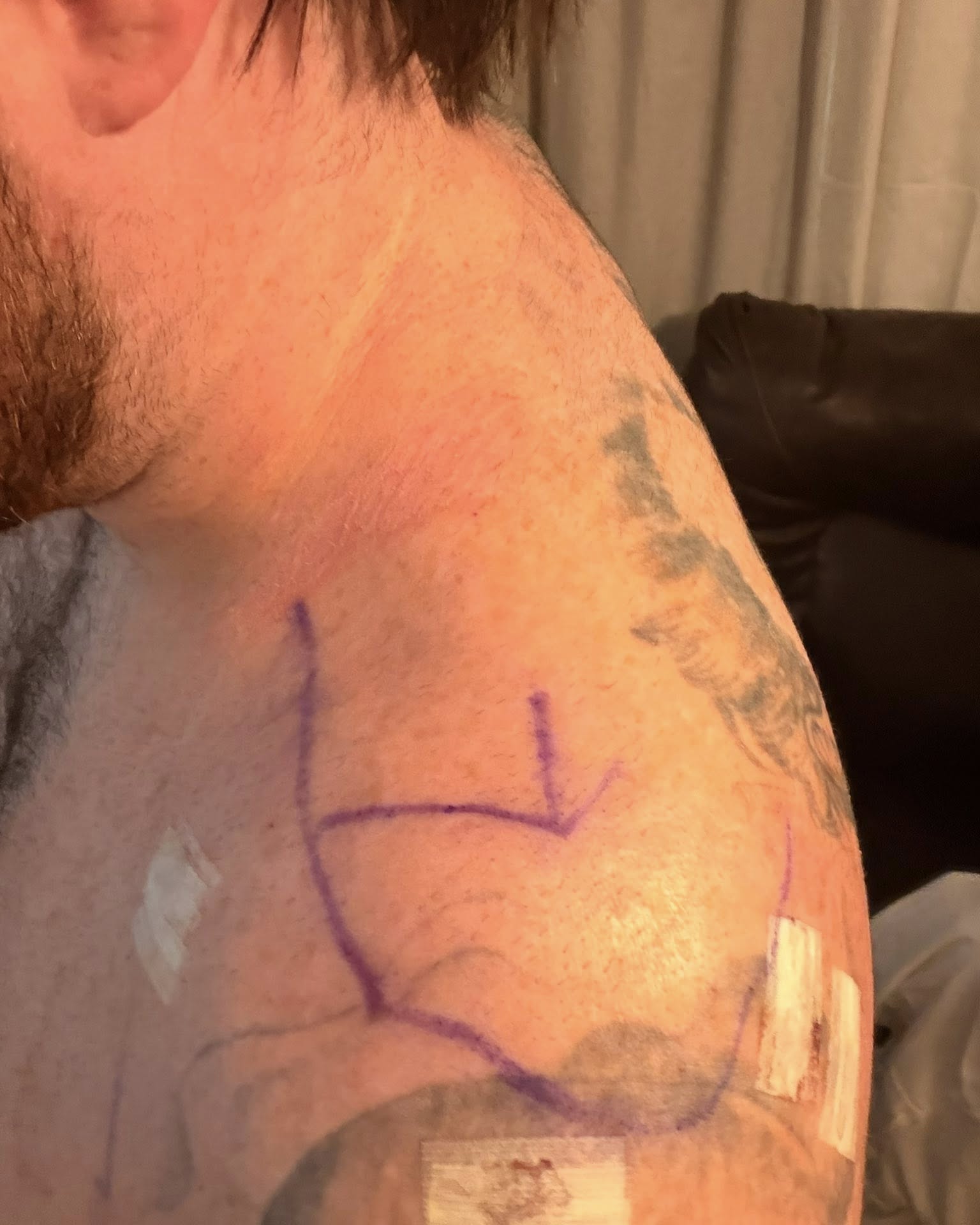 After years of my shoulder repeatedly dislocating, grinding, slipping out of place, and causing constant…